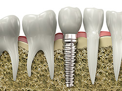 implants hardware